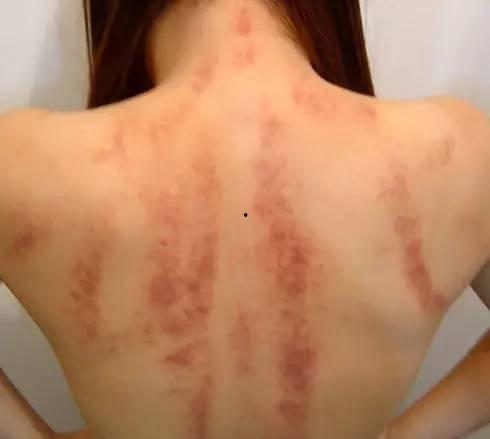 女人后背刮痧图片